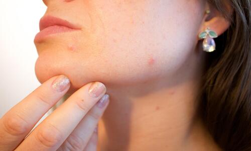 Natural Skin Care For Pimples