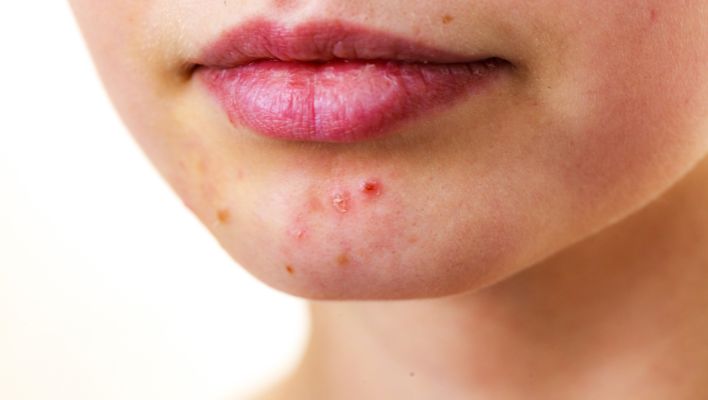 Skin Care For Cystic Acne