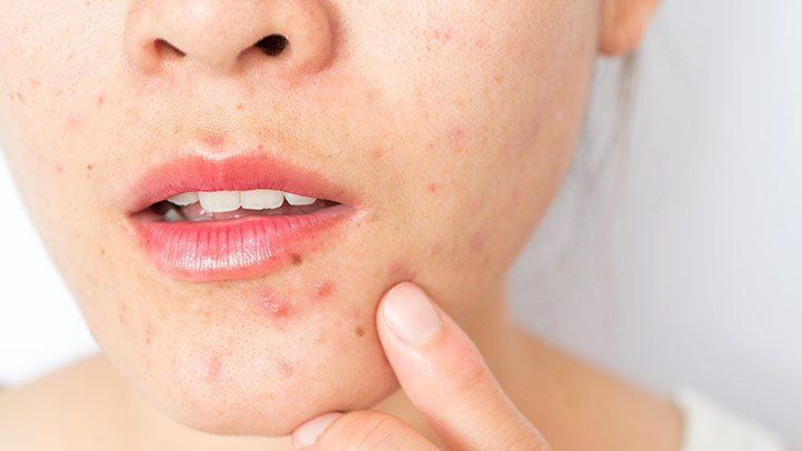 Can Facial Hair Cause Acne