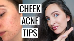 How to Get Rid of Acne on Cheeks