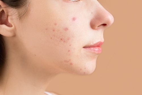 How to Get Rid of Acne under the Skin