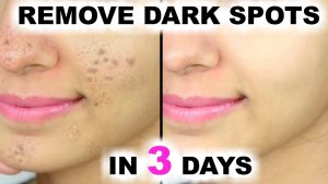 removal of dark spots from acne
