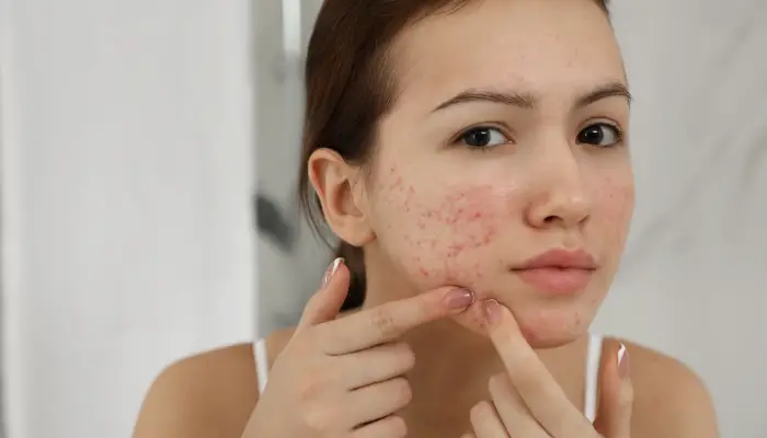 Serum for Acne-Prone Skin
