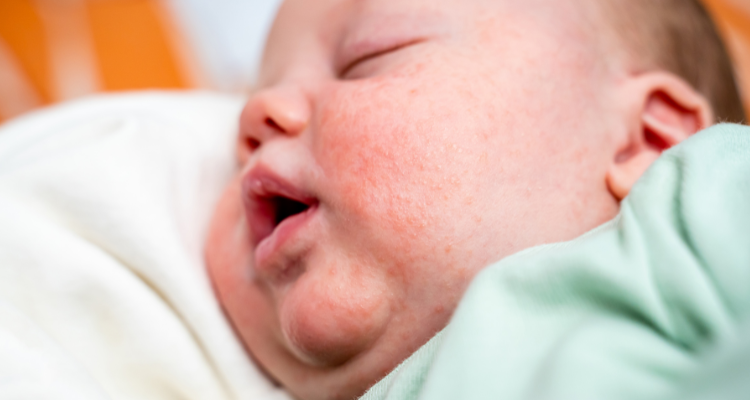  treatment of baby acne